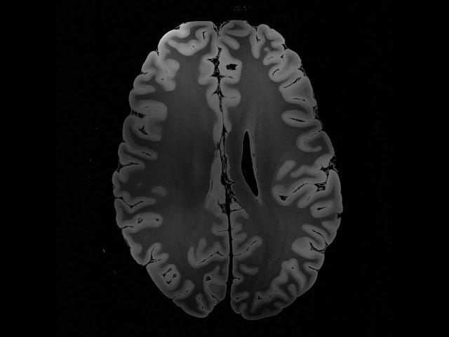 VIDEO 1 100 MICRON MRI ACQUIRED FA25 AXIAL