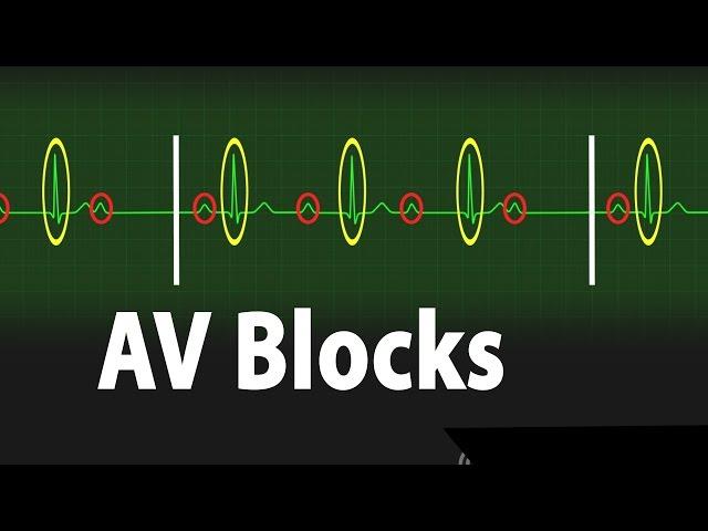 Atrioventricular Block (AV block) - Types of Heart Block Part 2, Animation.