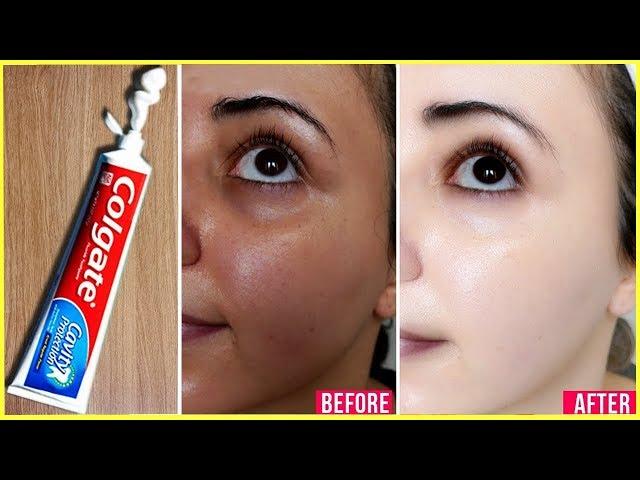 Apply Toothpaste on Your Skin and See Magical Result within 1 Hour ¦Amazing Toothpaste Beauty Hacks