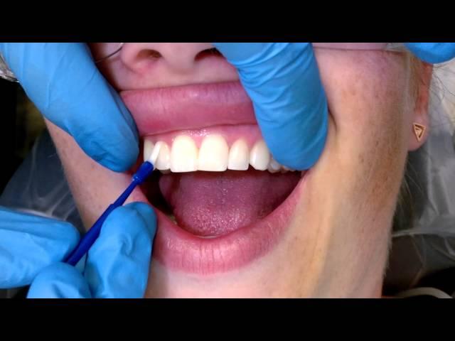 Tips For Applying Fluoride Varnish