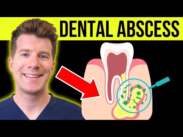 Doctor explains DENTAL ABSCESS (tooth abscess) | Causes, symptoms & treatment