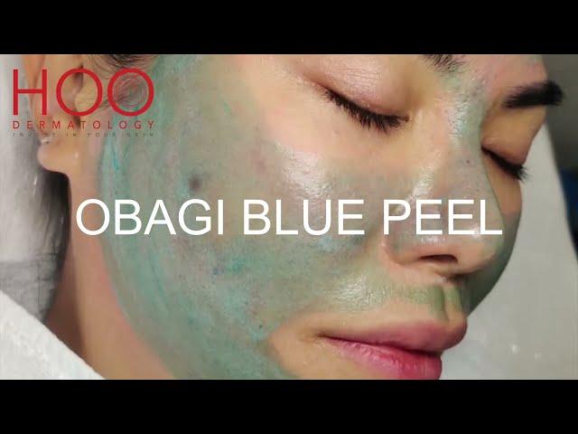 OBAGI BLUE PEEL TREATMENT