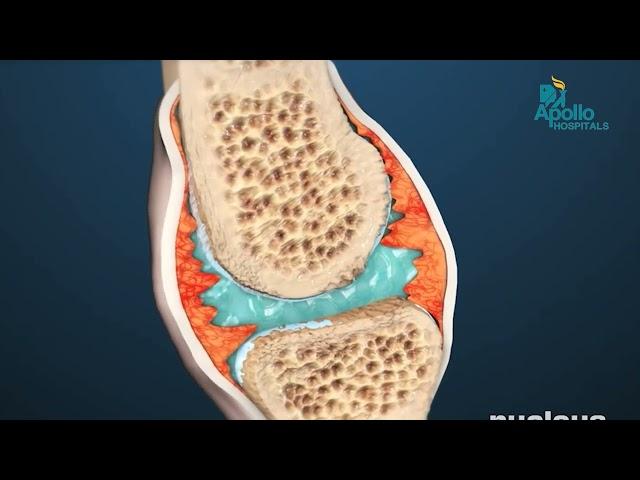 Rheumatoid Arthritis Treatment