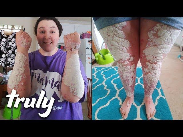 My Body Is 90% Covered In Psoriasis | TRULY