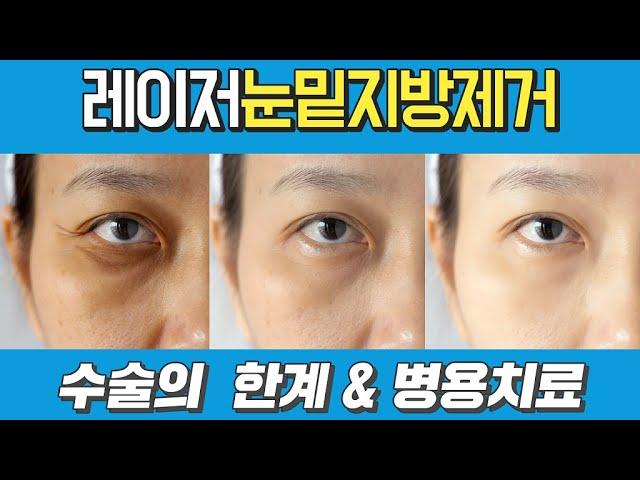 레이저 눈밑지방제거 한계와 병용치료 해결 방법을 강남테마피부과에서 소개합니다.