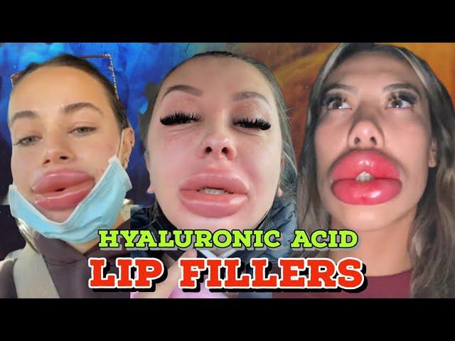 LIP INJECTIONS WITH NO NEEDLE??