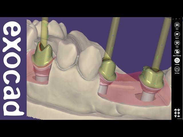 exocad Video Tutorial (basic): Custom Abutment Design