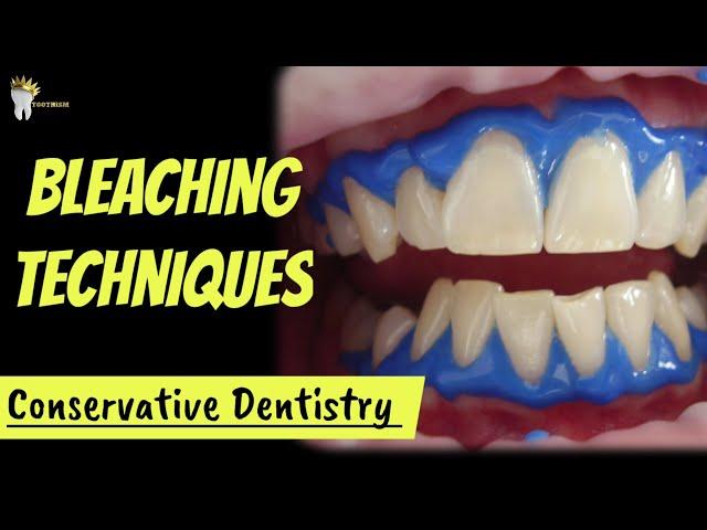 OPERATIVE DENTISTRY BLEACHING TECHNIQUES- IN OFFICE BLEACHING AND AT HOME BLEACHING