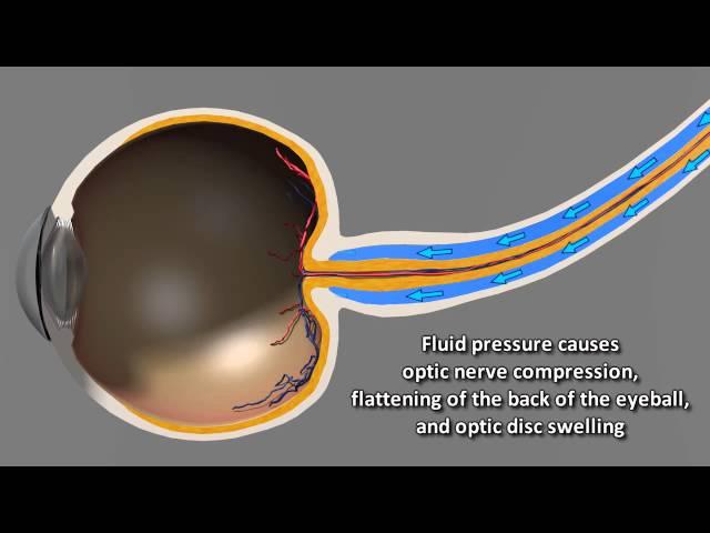 Astronaut Vision Changes in Microgravity