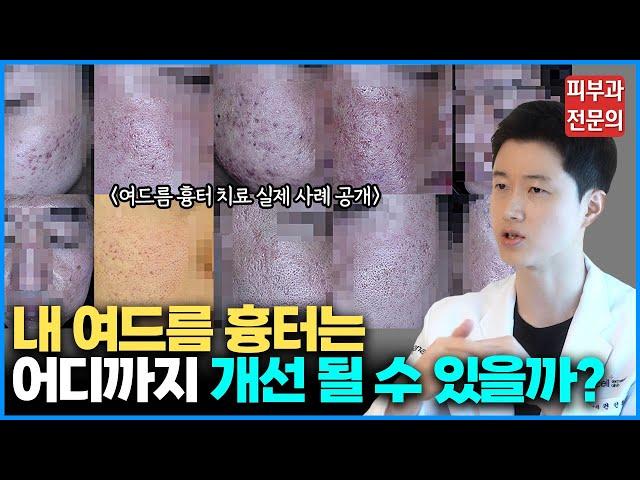 수많은 치료를 받아도 내 여드름 흉터가 낫지 않는 이유 / 여드름 흉터 치료의 본질을 알려드립니다