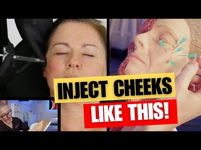 How To Inject The Cheeks. Cheek Injection Points Tutorial.