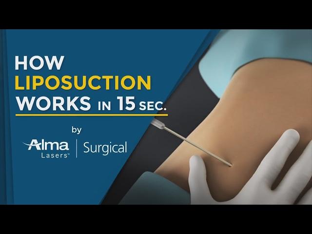 How Liposuction Works in 15 Seconds (Medical Technology 3D Animation 2020)