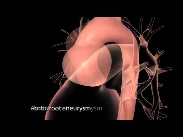 Aortic Disease: Aortic Aneurysm and Dissection