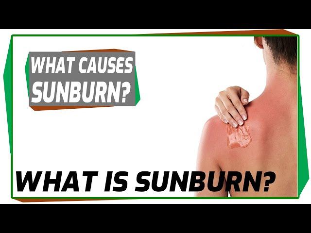 What is Sunburn? Sunburn, Causes, Signs and Symptoms, Diagnosis and Treatment