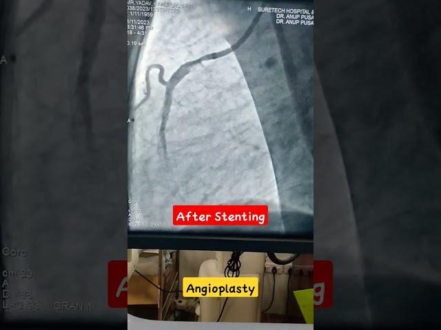 Coronary Stenting | Medico Lifestyle | #doctor #vlog #nursing #medicalvlog #viral