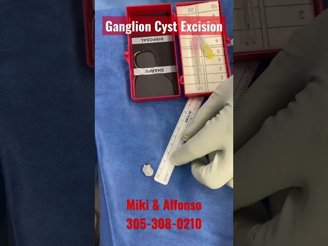 Ganglion Cyst Excision