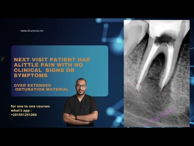 clinical case - 16 Retreatment of lower first molar with larg periapical lesion - 4 years follow up