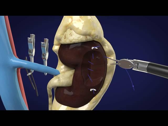 Partial Nephrectomy