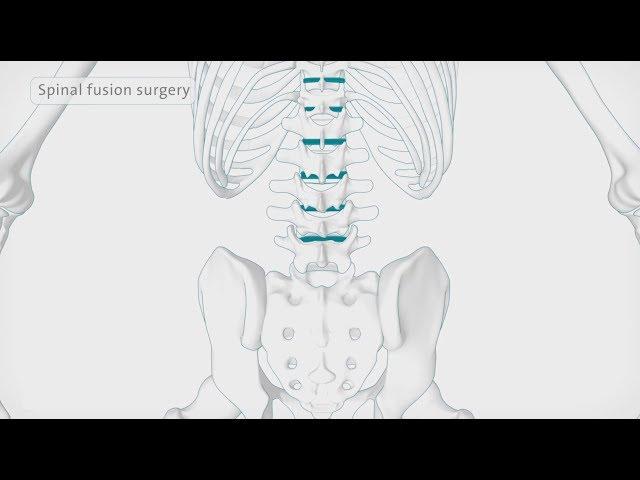 How back surgery (spinal fusion) is performed | Spire Healthcare