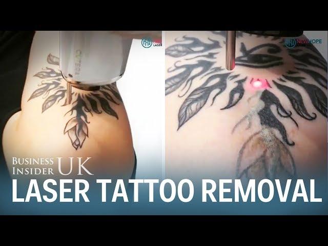 This is how laser tattoo removal works