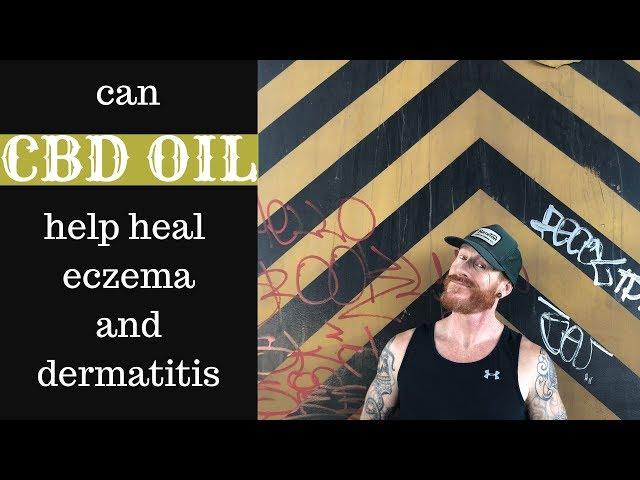 Can CBD oil (cannabis oil) help heal Eczema and Dermatitis?