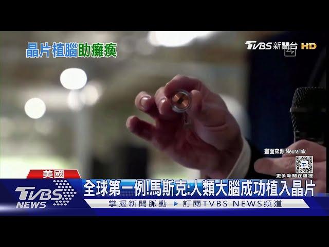 全球首例!馬斯克X平台宣布 人類大腦成功植入晶片｜TVBS新聞 @TVBSNEWS01