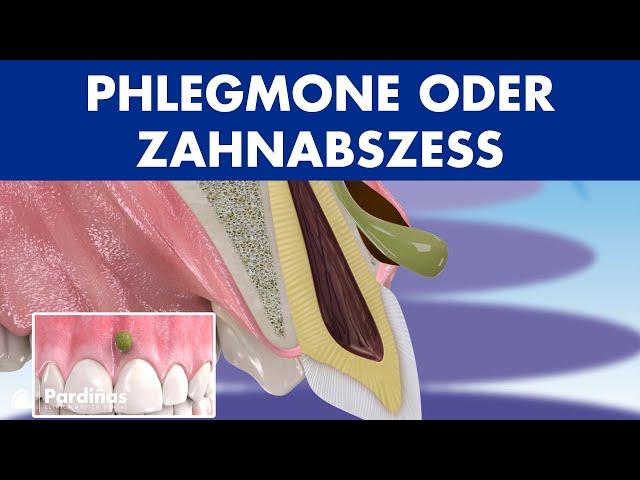 PHLEGMONE - Symptome und Behandlung von ABSZESS Zahnfleisch ©