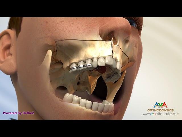 Surgical Orthodontic Treatment for Constricted Upper Jaw - SARPE