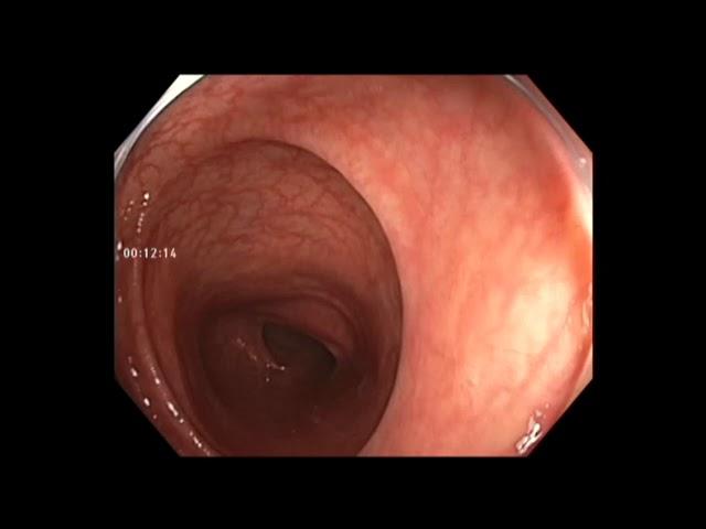 Colonoscopy: