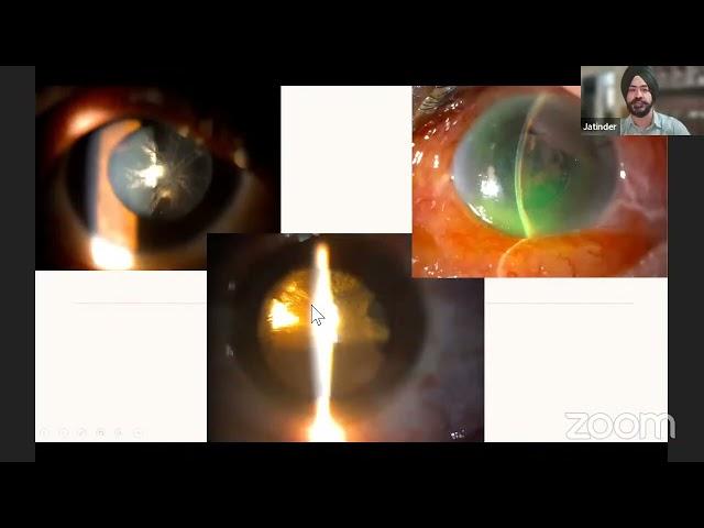 THE INTRICACIES OF MACULAR HOLE SURGERIES Dr  Sripathi Kamath & Dr  Jatinder Singh Debate