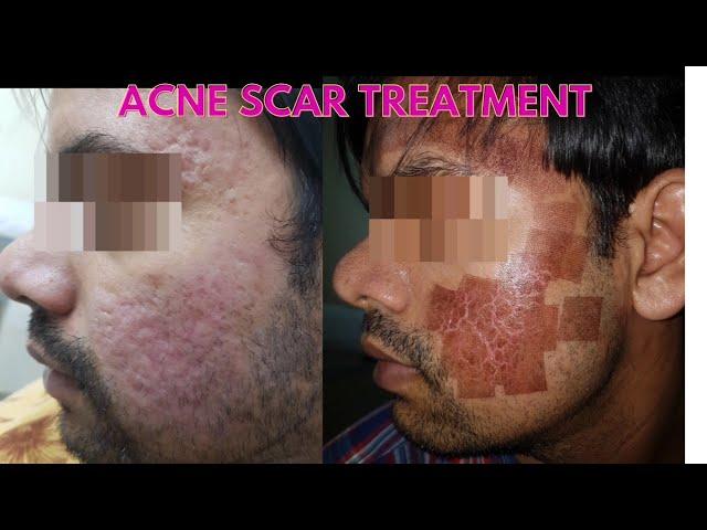 Laser acne scar removal || Before and after results || Laser treatment for scars