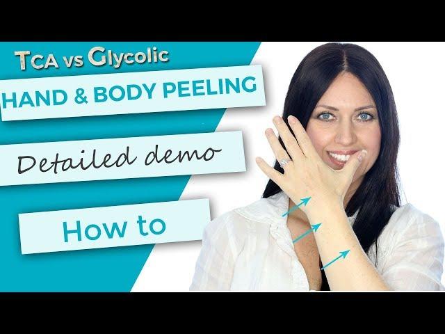 Hand and Body Peeling | Tutorial | Demonstration | TCA 30 versus Glycolic 70