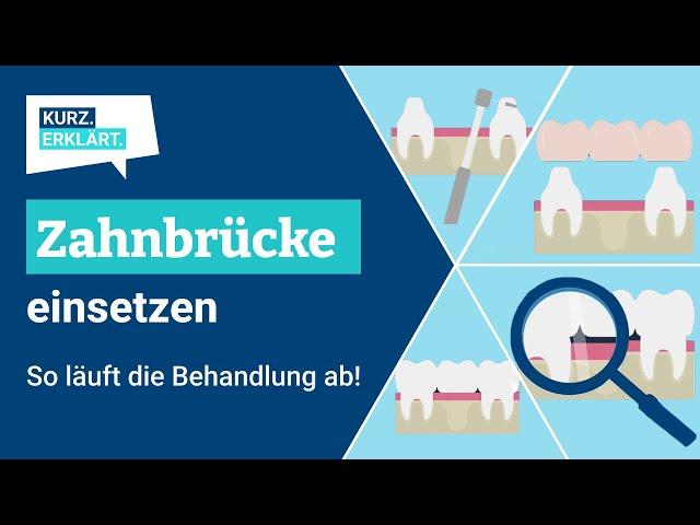 Zahnbrücke einsetzen: So läuft die Behandlung ab!