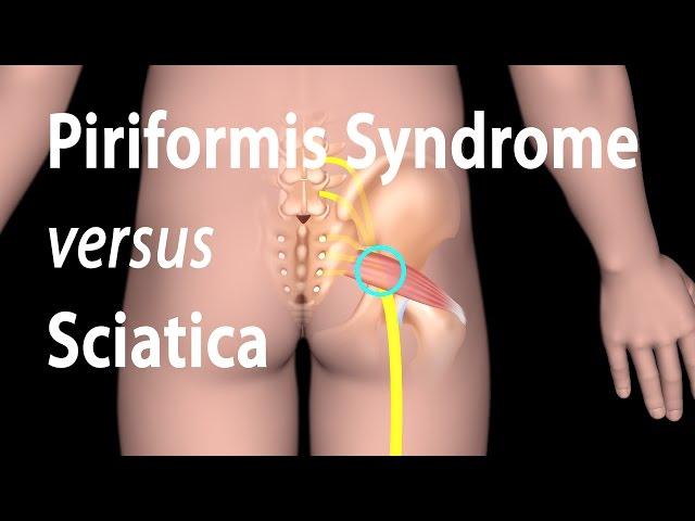 Piriformis Syndrome versus Sciatica, Animation.