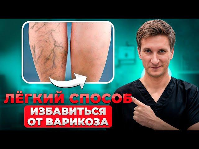 КАК Избавиться от Сосудистой сетки и Варикоза НАВСЕГДА? Рекомендации Флеболога