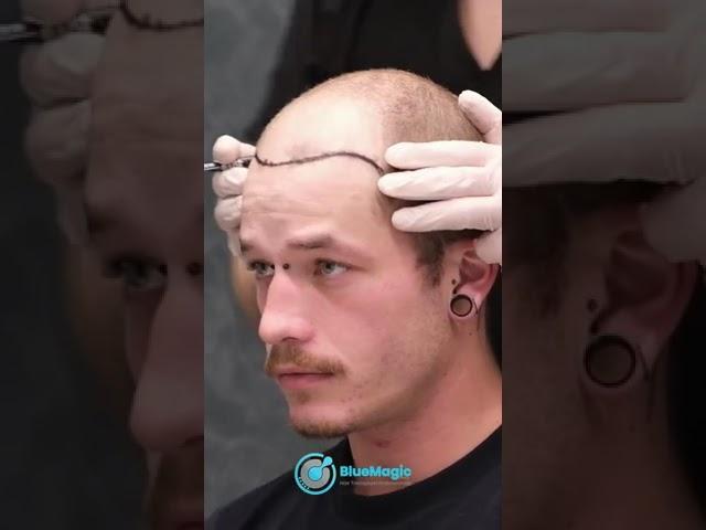 Hair Transplant Surgery | Using The Latest Technology & Techniques