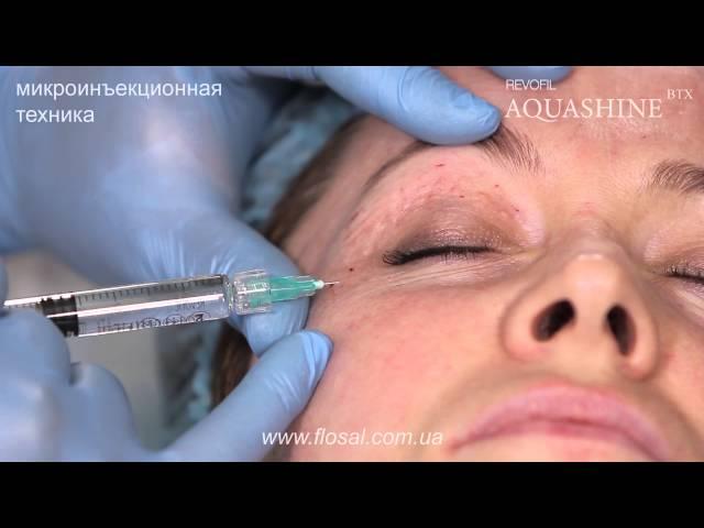 AQUASHINE BTX, микроинъекционная техника в периорбитальной области [ FloSal ]