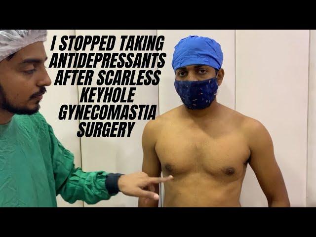 I Stopped Taking Antidepressants After Scarless Keyhole Gynecomastia Surgery In India