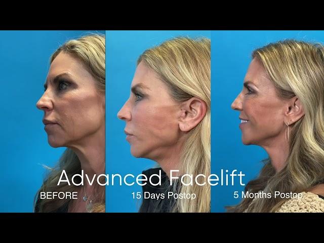 Dynamic Photos Showing Before Facelift - 15 days post Facelift & Final Results