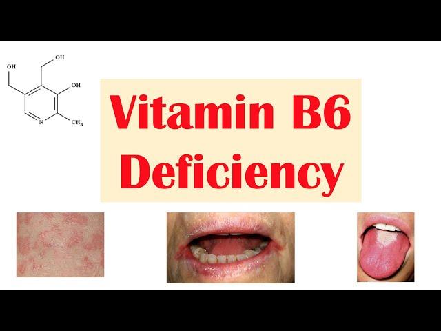 Vitamin B6 (Pyridoxine) Deficiency | Dietary Sources, Causes, Signs & Symptoms, Diagnosis, Treatment