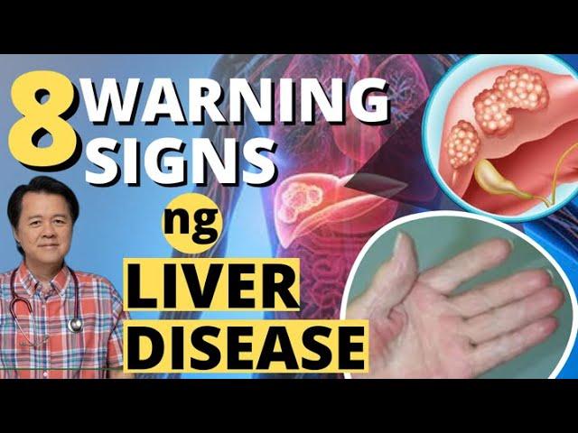 8 Warning Signs ng Liver Disease - Payo ni Doc Willie Ong #1344