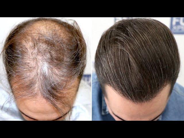 FUE Hair Transplant (3586 Grafts NW V Vertex) by Dr Juan Couto - FUEXPERT CLINIC - Madrid, Spain