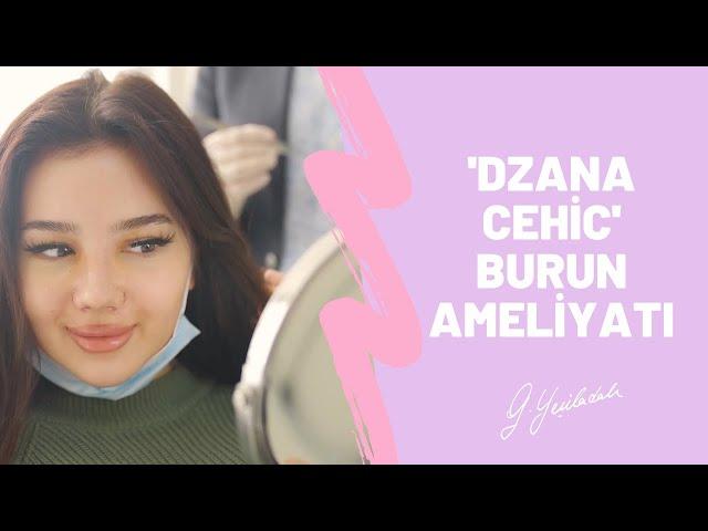 Dzana Cehic | Burun Estetiği | Op.Dr. Güray Yeşiladalı #burunestetiği #rhinoplasty