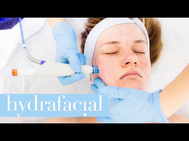 How does HydraFacial treatment work?