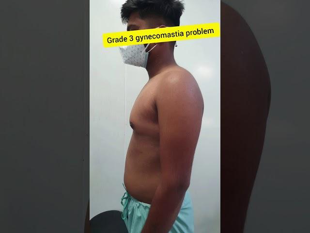 Grade 3 Gynecomastia Treated by Liposuction and Gland Removal Only @Divine