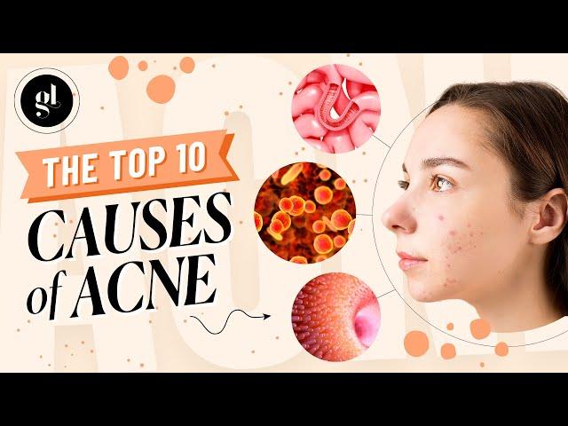 The Top 10 Causes of Acne