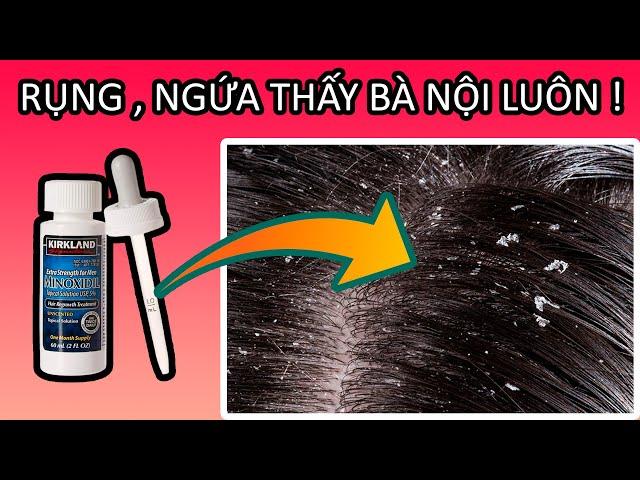 Kinh Nghiệm Loại Bỏ Vảy Gàu do Minoxidil Gây Ra | Tóc Nhiều Đẹp Trai #19