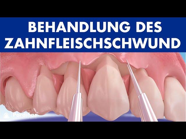 Koronaler Verschiebelappen zur Behandlung des Zahnfleischschwund ©