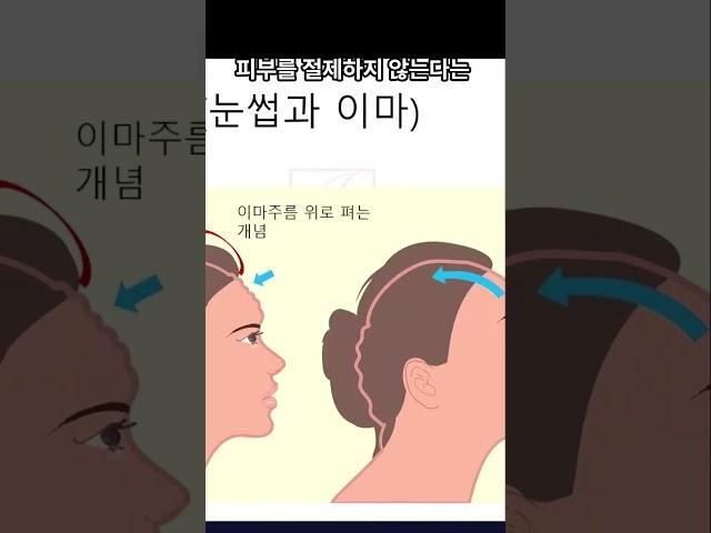 내시경 리프팅 - 제이제이성형외과 #shorts
