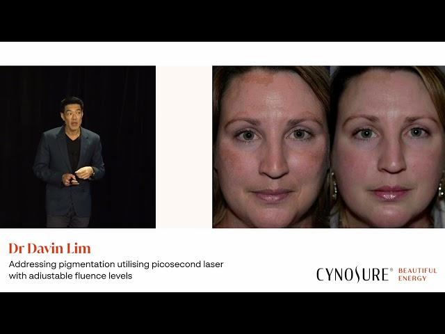 Dr Davin Lim | Picosure Pro | Cosmedicon 2023